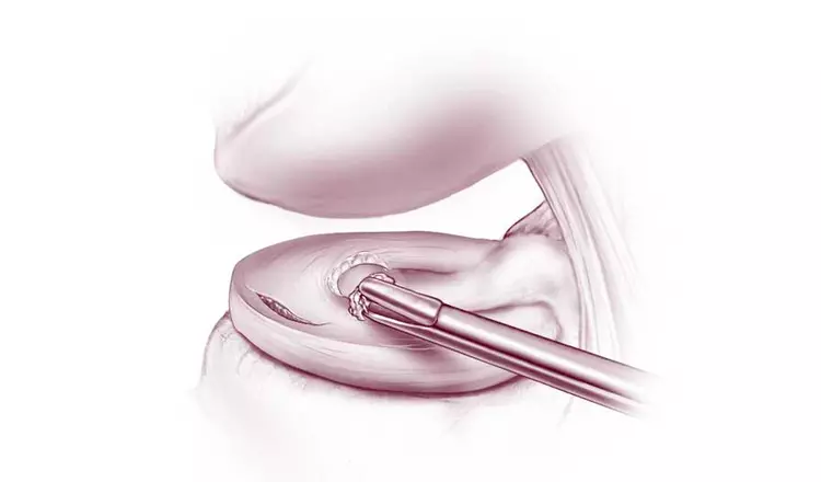 Cirurgia de meniscetomia realizada por vídeo