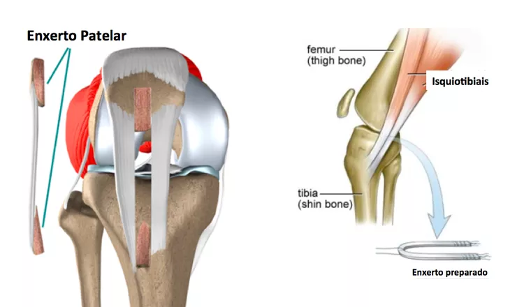 Enxerto Patelar e Enxerto Preparado