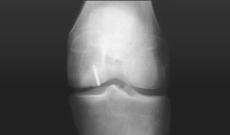 Radiografia do joelho