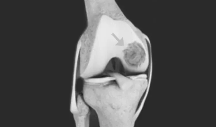 lesão de cartilagem do joelho