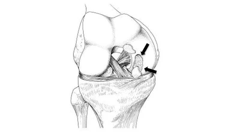 Osteocondrite dissecante