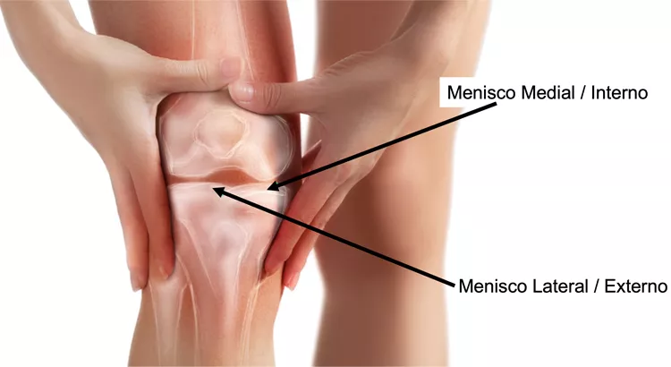 Menisco: o que é, lesões e tratamento | Dr. Guilherme Gracitelli