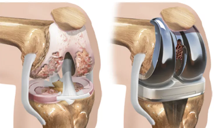 Prótese total de joelho