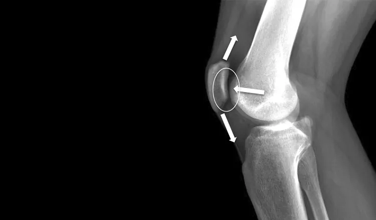 Vista lateral de uma radiografia do joelho