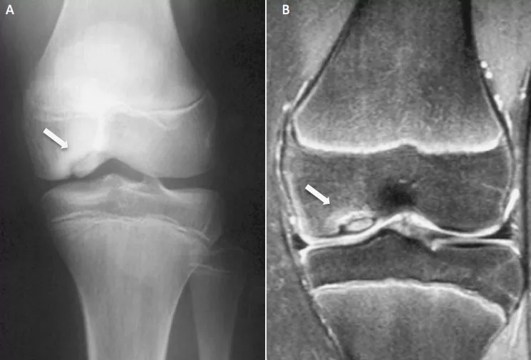 Radiografia e ressonância Magnética lesão da osteocondrite dissecante