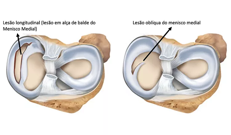 Tipos lesões dos meniscos