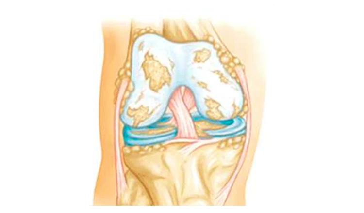 Artrose no joelho