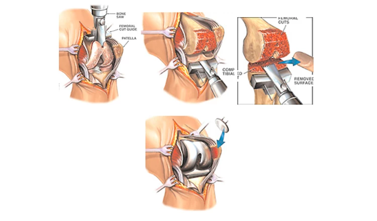 cirurgia de prótese total do joelho