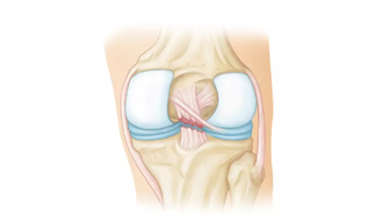 Ligamento Cruzado posterior (LCP)