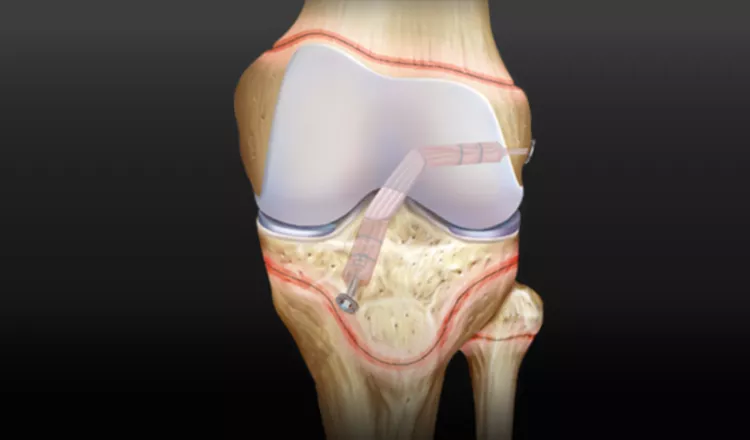 reconstrução anatômica do ligamento cruzado anterior