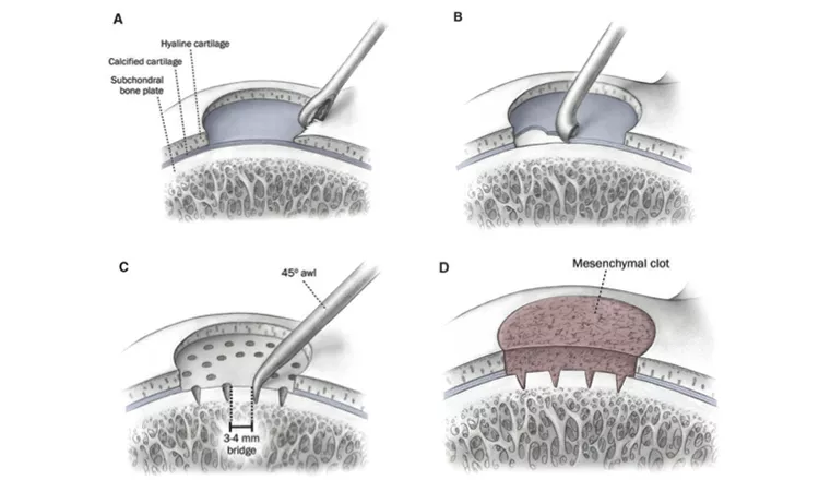 Tratamento pela técnica microfatura