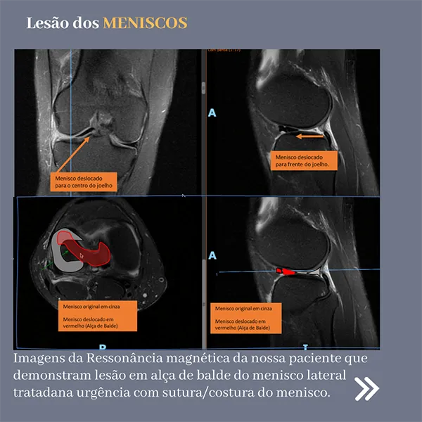 Ressonância mostrando lesão dos meniscos